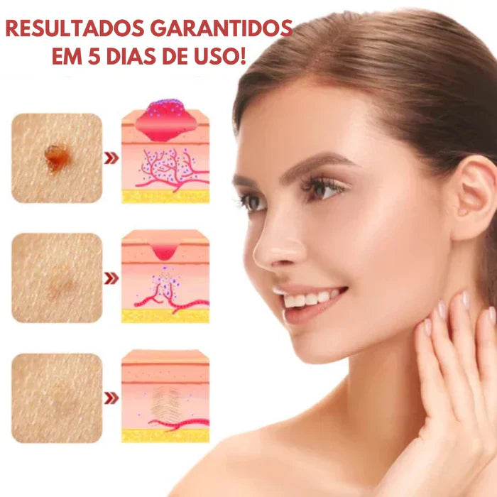 Removix - Remova Verrugas, Manchas e Marcas com Rapidez e Eficácia! BRINDE ESPECIAL